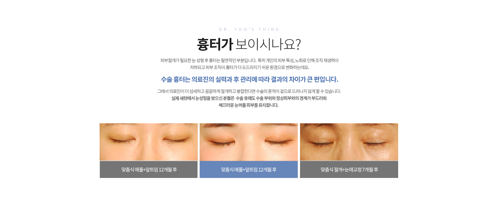 흉터가 보이시나요? 
		피부절개가 필요한 눈 성형 후 흉터는 필연적인 부분입니다. 

		특히 개인의 피부 특성, 노화로 인해 조직 재생력이 저하되고 피부 조직이 흉터가 더 도드라지기 쉬운 환경으로 변화하는데요. 

		수술 흉터는 의료진의 실력과 후 관리에 따라
		결과의 차이가 큰 편입니다. 
		그래서 의료진이 더 섬세하고 꼼꼼하게 절개하고 봉합한다면 수술의 흔적이 겉으로 드러나지 않게 할 수 있습니다. 

		실제 세현에서 눈성형을 받으신 분들은 
		수술 후에도 수술 부위와 정상피부와의 경계가 부드러워
		매끄러운 눈꺼풀 피부를 유지합니다.
