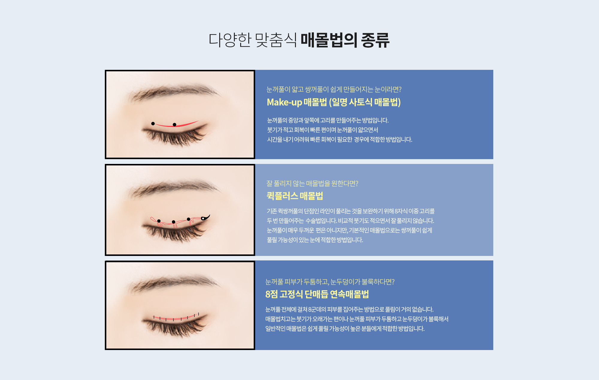 다양한 맞춤식 매몰법의 종류
		눈꺼풀이 얇고 쌍꺼풀이 쉽게 만들어지는 눈이라면? 
		Make-up 매몰법 (일명 사토식 매몰법)

		눈꺼풀의 중앙과 앞쪽에 고리를 만들어주는 방법입니다. 
		붓기가 적고 회복이 빠른 편이며 눈꺼풀이 얇으면서 시간을 내기 어려워 빠른 회복이 필요한 
		경우에 적합한 방법입니다. 

		잘 풀리지 않는 매몰법을 원한다면? 
		퀵플러스 매몰법

		기존 퀵쌍꺼풀의 단점인 라인이 풀리는 것을 보완하기 위해 8자식 이중 고리를 두 번 만들어주는 
		수술법입니다. 비교적 붓기도 적으면서 잘 풀리지 않습니다. 
		눈꺼풀이 매우 두꺼운  편은 아니지만, 기본적인 매몰법으로는 쌍꺼풀이 쉽게 풀릴 가능성이 있는 
		눈에 적합한 방법입니다. 

		눈꺼풀 피부가 두툼하고, 눈두덩이가 불룩하다면? 
		8점 고정식 단매듭 연속매몰법

		눈꺼풀 전체에 걸쳐 8군데의 피부를 집어주는 방법으로 풀림이 거의 없습니다. 
		매몰법치고는 붓기가 오래가는 편이나 눈꺼풀 피부가 두툼하고 눈두덩이가 불룩해서
		일반적인 매몰법은 쉽게 풀릴 가능성이 높은 분들에게 적합한 방법입니다.