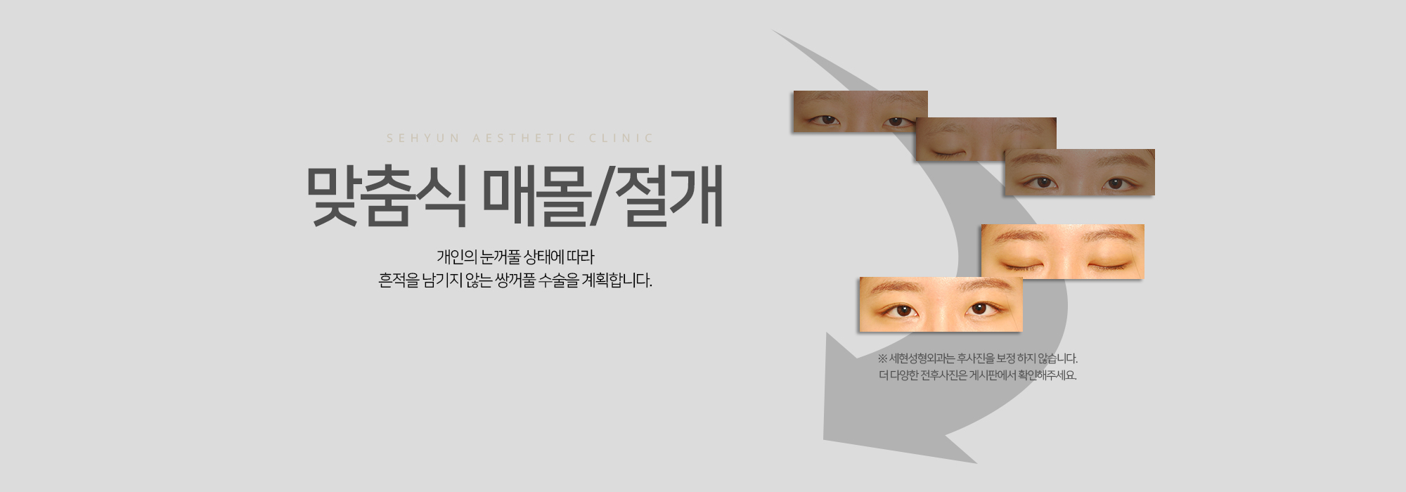 맞춤식 매몰 / 절개 개인의 눈꺼풀 상태에 따라 흔적을 남기지 않는 쌍꺼풀 수술을 계획합니다.