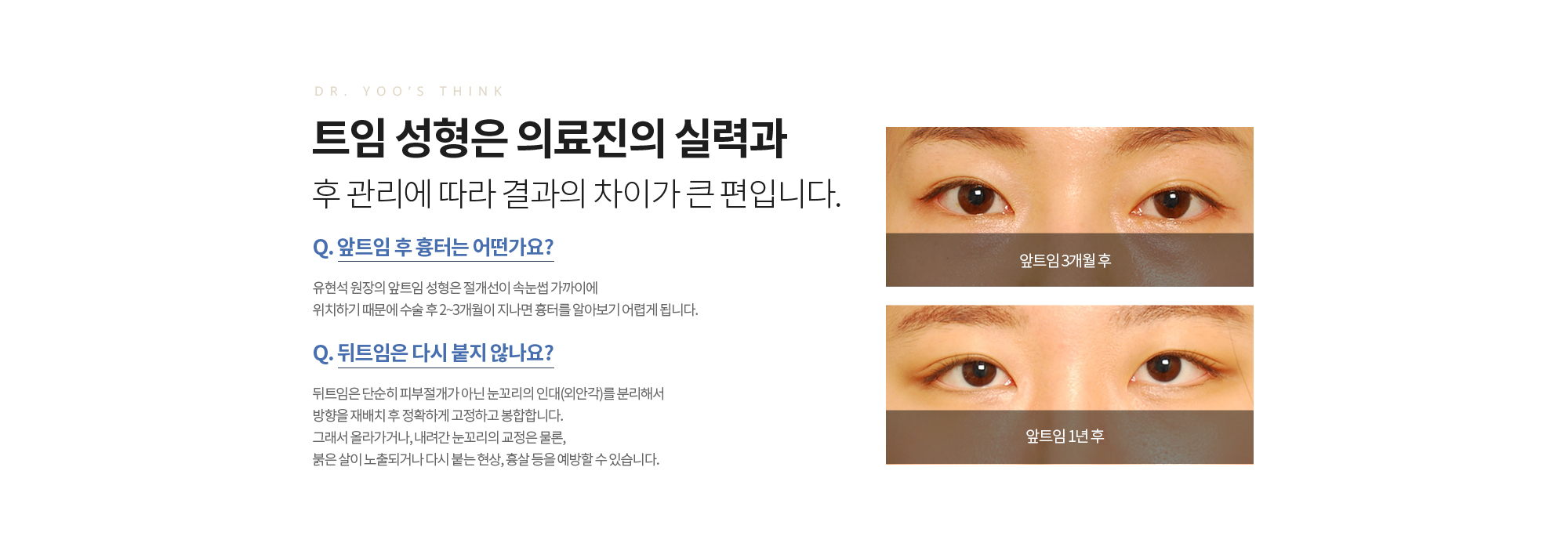 세현의 트임 성형은 재배치와 완전한 봉합으로 다시 붙는 현상 없이 
		만족스러운 결과를 추구합니다.