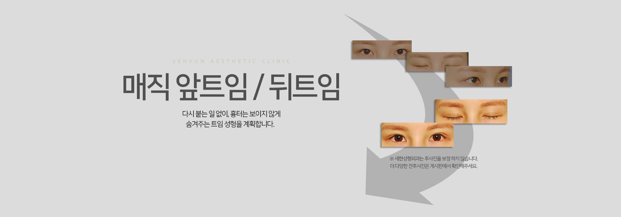 매직 앞트임 / 뒤트임 다시 붙는 일 없이, 흉터는 보이지 않게 숨겨주는 트임 성형을 계획합니다.