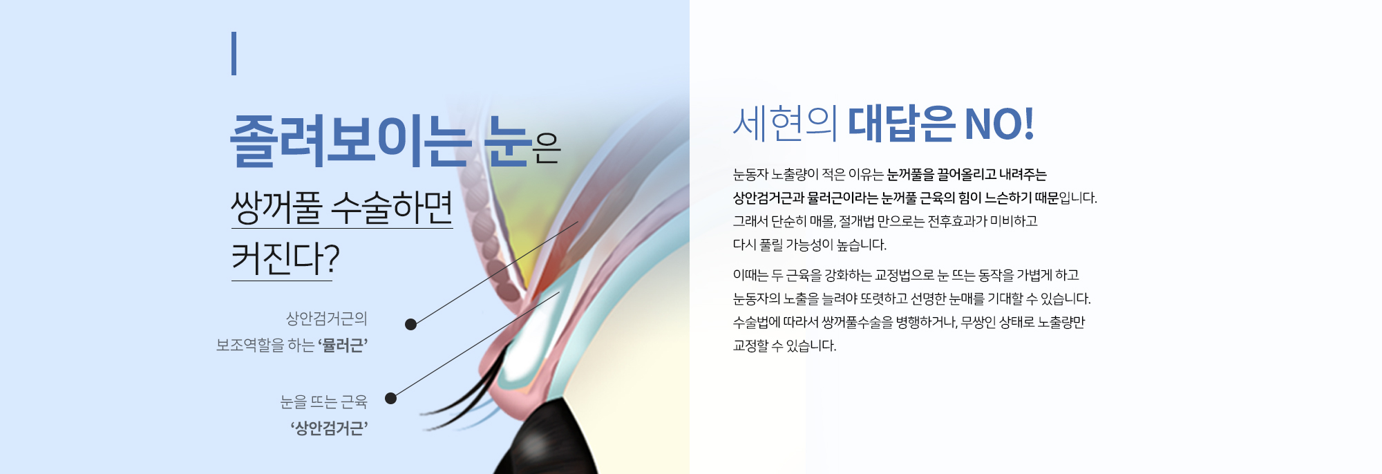 졸려보이는 눈은 쌍꺼풀 수술하면 커진다?
		세현의 대답은 NO
		윗눈꺼풀이 눈동자를 많이 가려서 노출량이 적은 분들이 단순히 매몰, 절개 등으로 
		쌍꺼풀 수술을 하면 다시 풀리거나, 전후 변화가 크지 않아 만족도가 떨어질 수 있습니다. 

		이유는 눈꺼풀을 끌어올리고 내려주는 상안검거근과 뮬러근이라는 
		눈꺼풀 근육의 힘이 없고 느슨하기 때문입니다. 

		이를 안검하수라고 하는데 눈매교정은 두 근육을 강화하는 교정법을 통해
		눈을 뜨는 동작을 가볍게 하고, 눈동자의 노출이 더 많이 되면서 
		또렷하고 선명한 눈매를 완성하는 수술입니다. 

		수술법에 따라서 안검하수와 동시에 쌍꺼풀을 만들 수도 있고, 
		쌍꺼풀을 만들고 싶지 않다면 무쌍인 상태로 눈동자의 노출 정도만
		교정하는 방법도 계획할 수 있습니다.