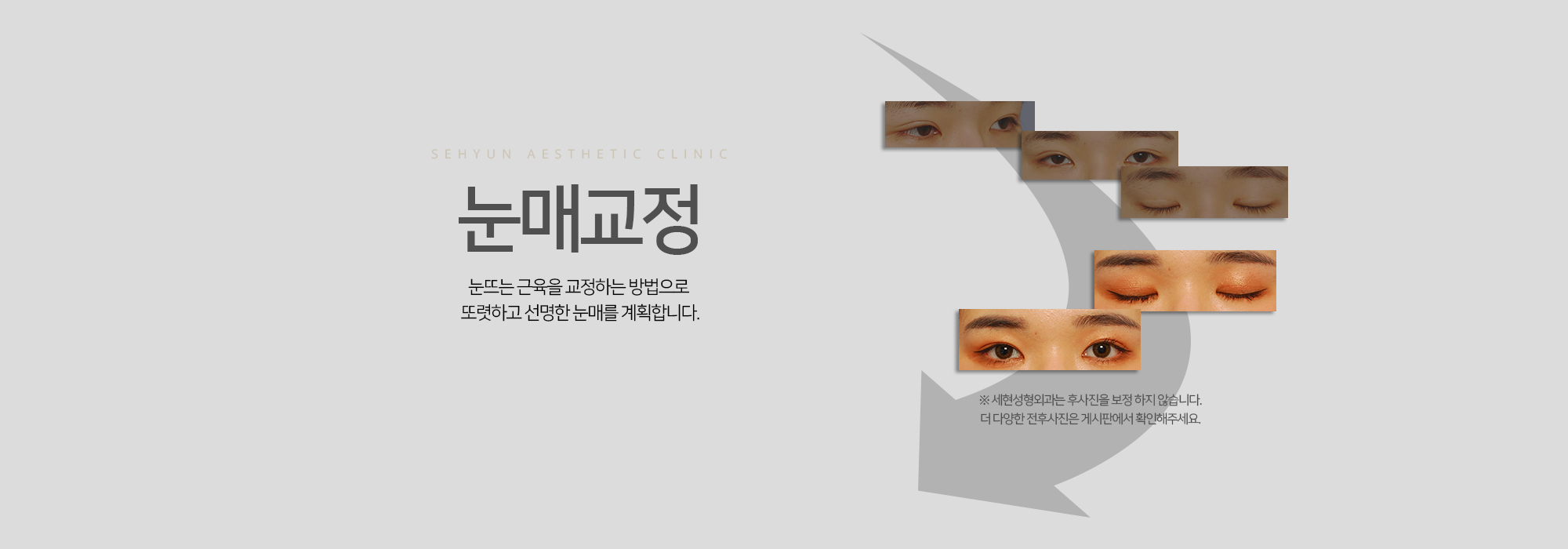 눈매교정 눈뜨는 근육을 교정하는 방법으로 또렷하고 선명한 눈매를 계획합니다.