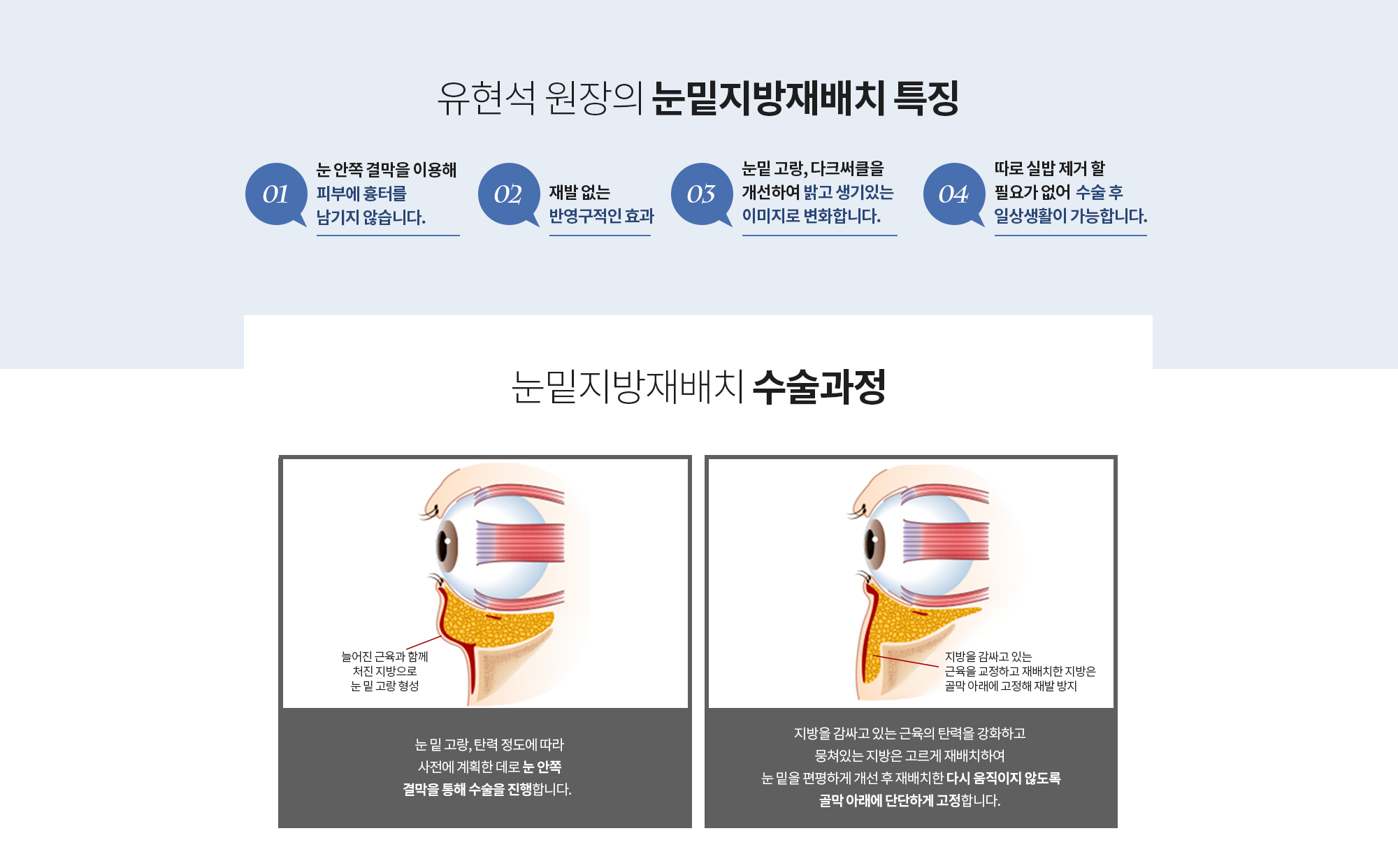 유현석 원장의 눈밑지방재배치 특징 
		눈 안쪽 결막을 이용해
		피부에 흉터를 남기지 않습니다. 
		재발 없는 반영구적인 효과
		눈밑 고랑, 다크써클을 개선하여
		밝고 생기있는 이미지로 변화합니다. 
		따로 실밥 제거 할 필요가 없어 
		수술 후 일상생활이 가능합니다.
		
		눈밑지방재배치 수술과정
		눈 밑 고랑, 탄력 정도에 따라
		사전에 계획한 데로 눈 안쪽 결막을 통해 수술을 진행합니다.  
		지방을 감싸고 있는 근육의 탄력을 강화하고 
		뭉쳐있는 지방은 고르게 재배치하여 
		눈 밑을 편평하게 개선 후 재배치한 다시 움직이지 않도록 골막 아래에 단단하게 고정합니다.