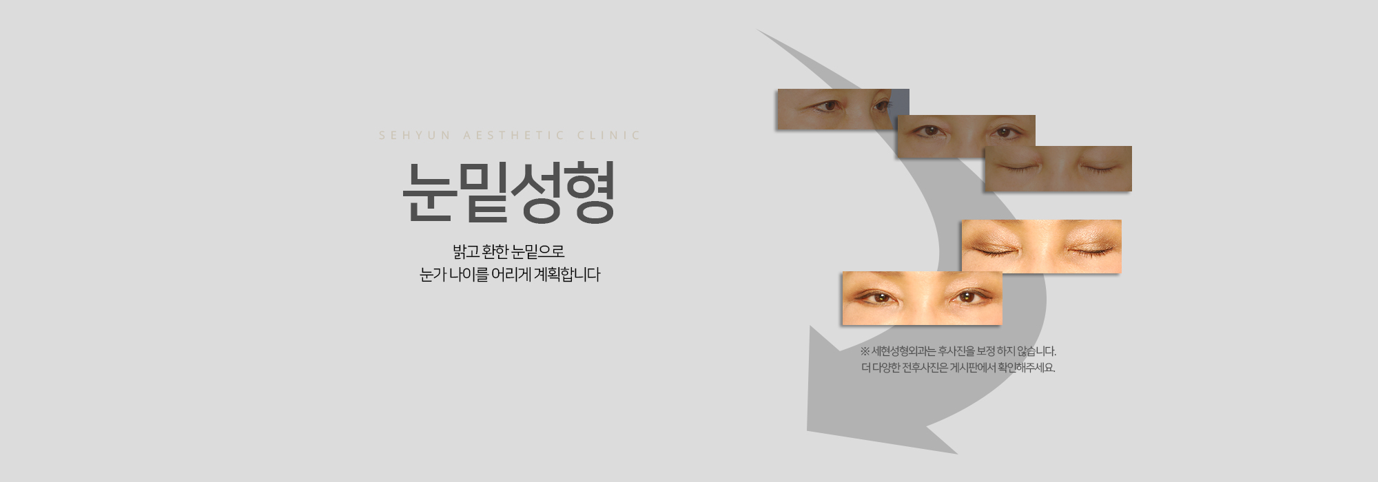눈밑성형 밝고 환한 눈밑으로 눈가 나이를 어리게 계획합니다.