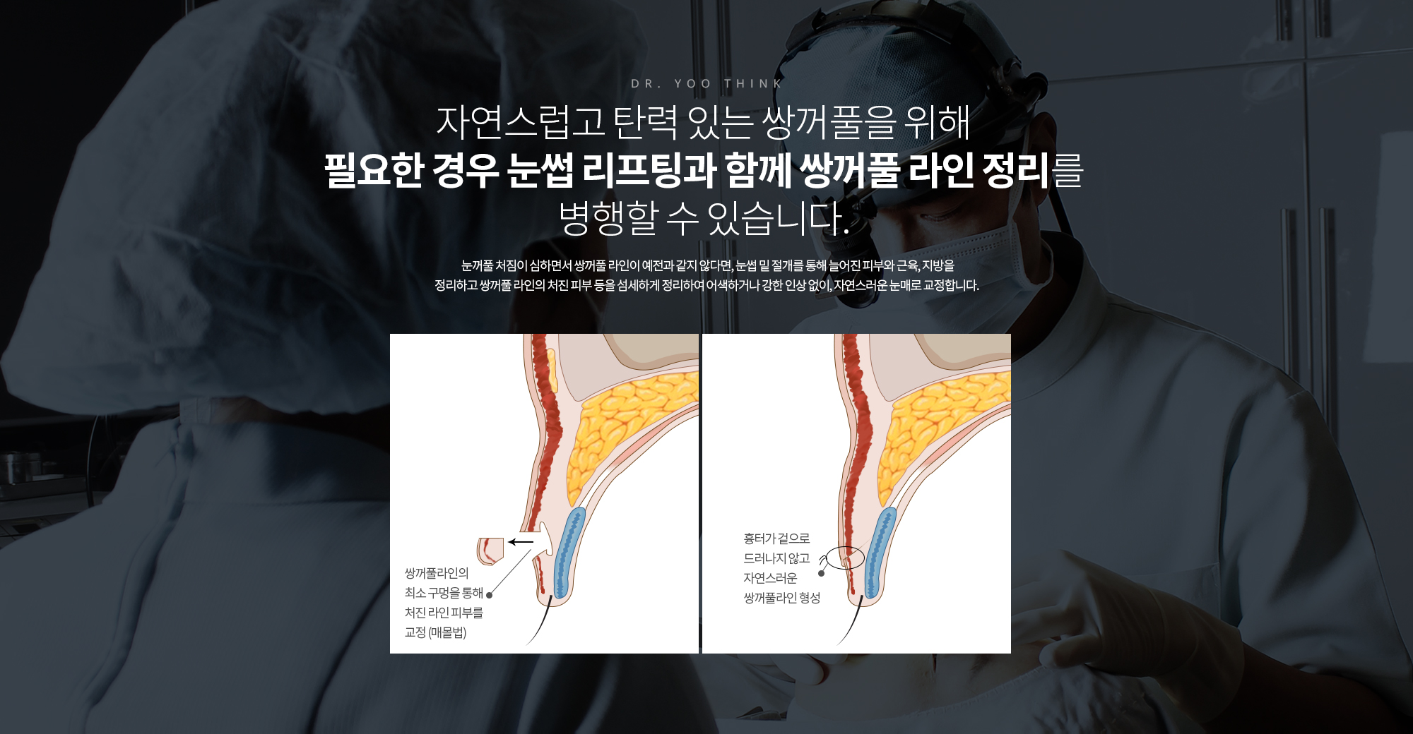 자연스럽고 탄력 있는 쌍꺼풀을 위해 
		필요한 경우 눈썹 리프팅과 함께 쌍꺼풀 라인 정리를 
		병행할 수 있습니다. 

		눈꺼풀 처짐이 심하면서 쌍꺼풀 라인이 예전과 같지 않다면, 눈썹 밑 절개를 통해 늘어진 피부와 근육, 지방을 정리하고 쌍꺼풀 라인의 처진 피부 등을 섬세하게 정리하여 어색하거나 강한 인상 없이, 자연스러운 눈매로 교정합니다.
