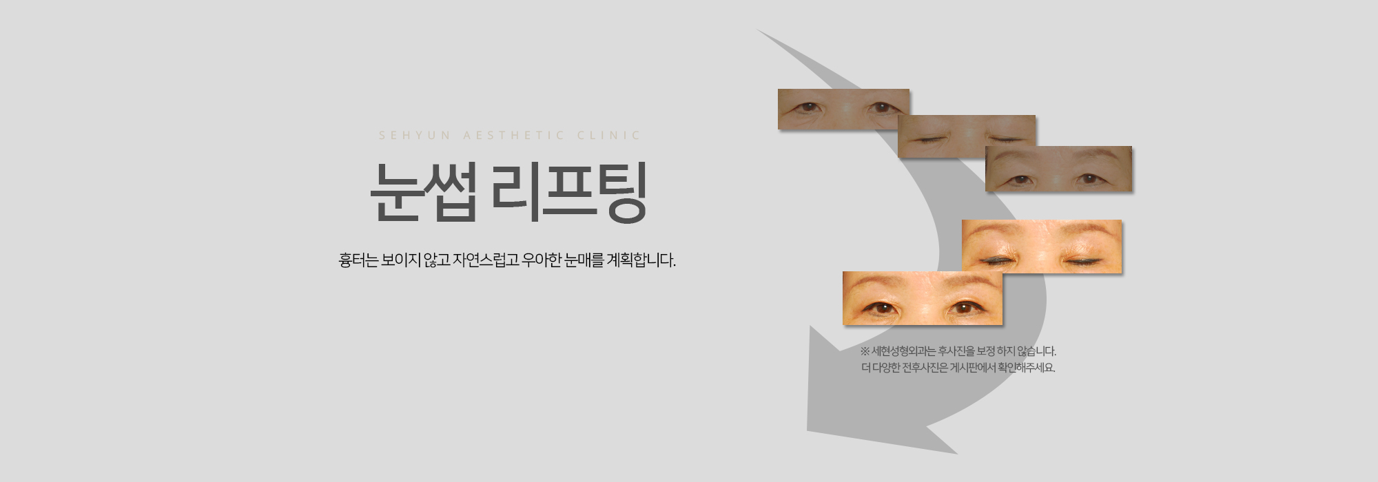 눈썹 리프팅 흉터는 보이지 않고 자연스럽고 우아한 눈매를 계획합니다.