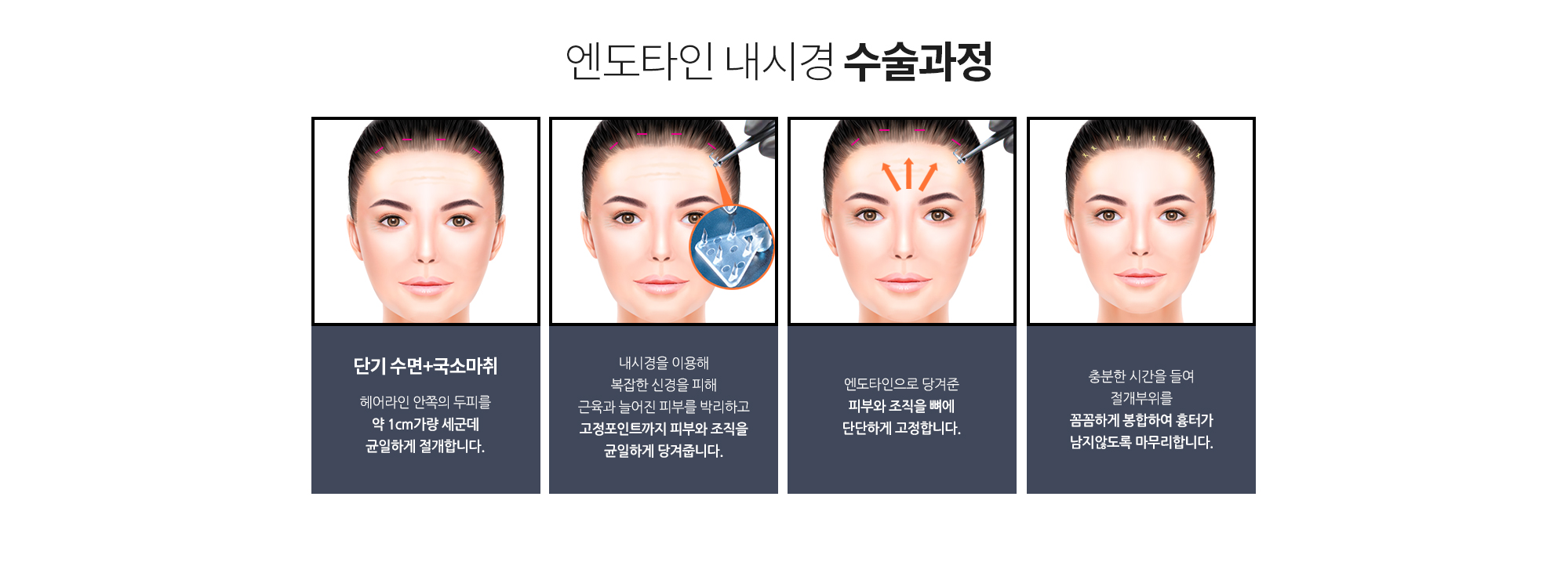 유현석 원장의 엔도타인 내시경 특징
		두피 최소절개로 
		수술흔적이 잘 보이지 않습니다.
		헤어라인을 길게 절개하는 
		일반 이마거상술과 달리 약 1cm가량 
		두피의 세군데만 포인트로 최소절개해 흉터가
		눈에 띄지 않습니다. 

		확실한 고정효과와 
		오랜 유지기간
		5개의 돌기가 달린 엔토타인을
		조직과 함께 뼈에 고정해 오랫동안 
		매끈한 탄력을 유지합니다. 

		흡수성 고정핀으로 
		안전지향
		생체 흡수성 고정핀으로 시간이 지나
		흡수되어 이물질에 의한 부작용이 없고,
		조직은 그대로 뼈에 단단하게 고정합니다. 

		이마주름, 눈썹처짐, 
		상안검 동시 개선
		한번의 수술로 이마주름, 눈썹처짐,
		눈꺼풀 처짐을 동시에 개선할 수 있습니다.
		
		엔도타인 내시경 수술과정
		단기 수면+국소마취 
		헤어라인 안쪽의 두피를 약 1cm가량 세군데 균일하게 절개합니다. 
		내시경을 이용해 복잡한 신경을 피해 근육과 늘어진 피부를 박리하고 고정포인트까지 피부와 조직을 균일하게 당겨줍니다.  
		엔도타인으로 당겨준 피부와 조직을 뼈에 단단하게 고정합니다.   
		충분한 시간을 들여 절개부위를 꼼꼼하게 봉합하여 흉터가 남지않도록 마무리합니다.