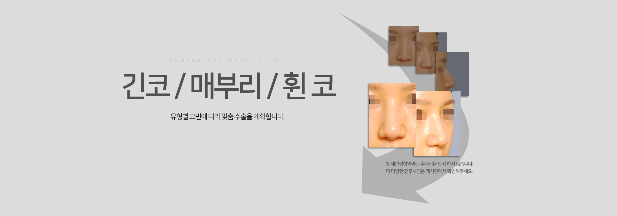 긴코 / 매부리 / 휜 코 유형별 고민에 따라 맞춤 수술을 계획합니다.