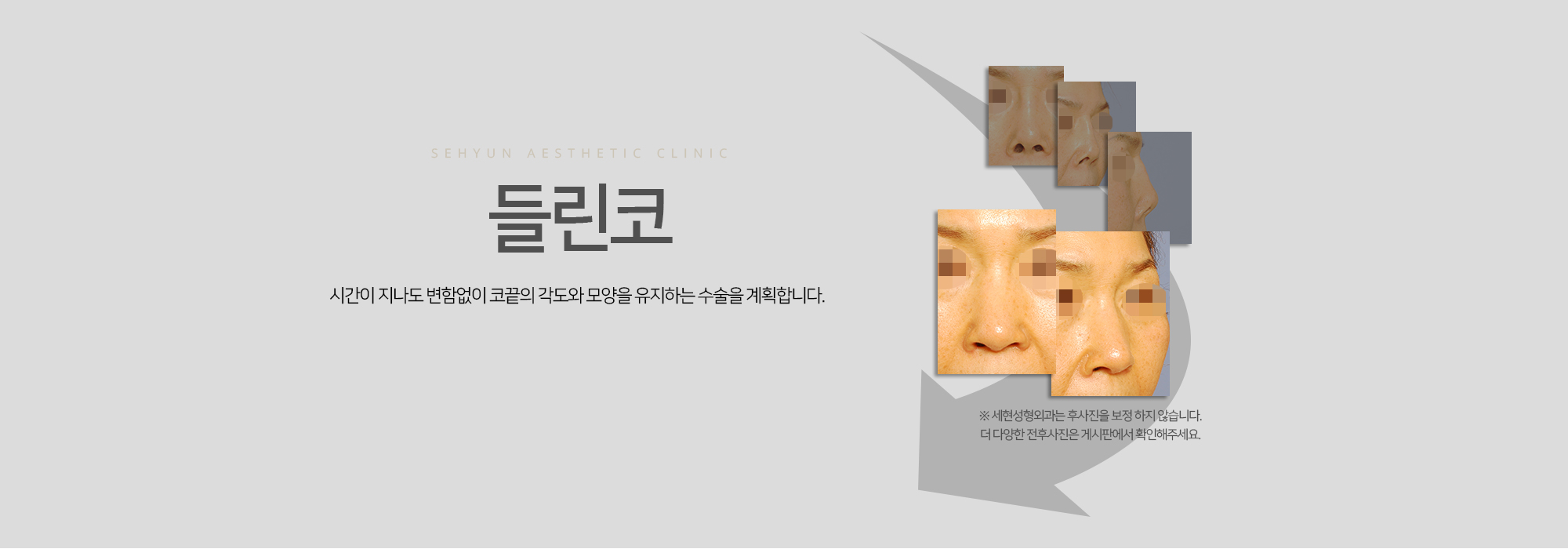 들린코 시간이 지나도 변함없이 코끝의 각도와 모양을 유지하는 수술을 계획합니다.