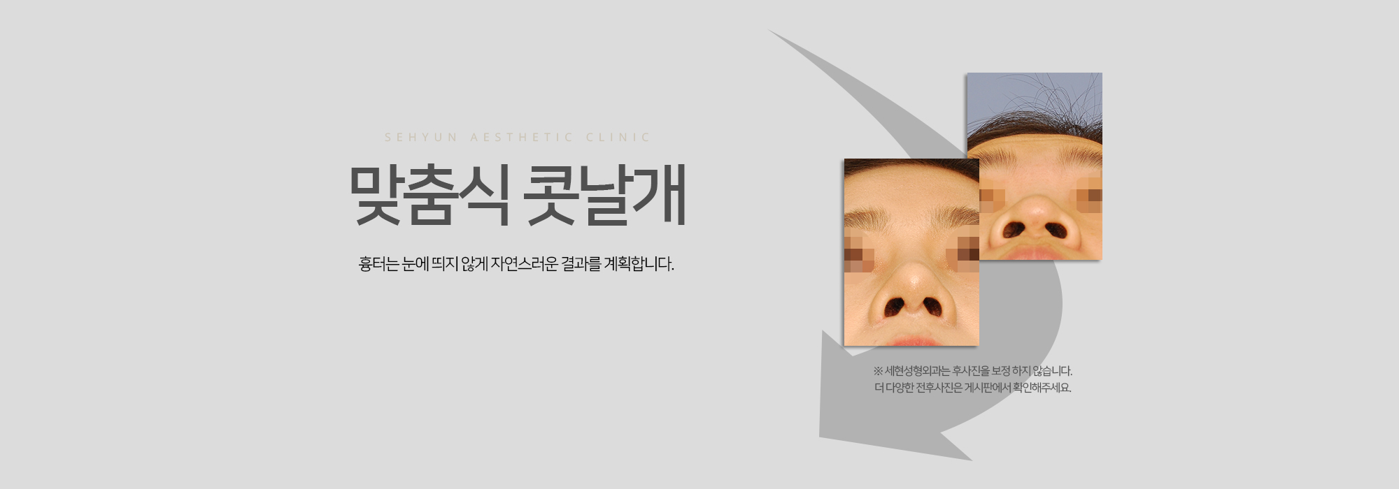 맞춤식 콧날개 흉터는 눈에 띄지 않게 자연스러운 결과를 계획합니다.