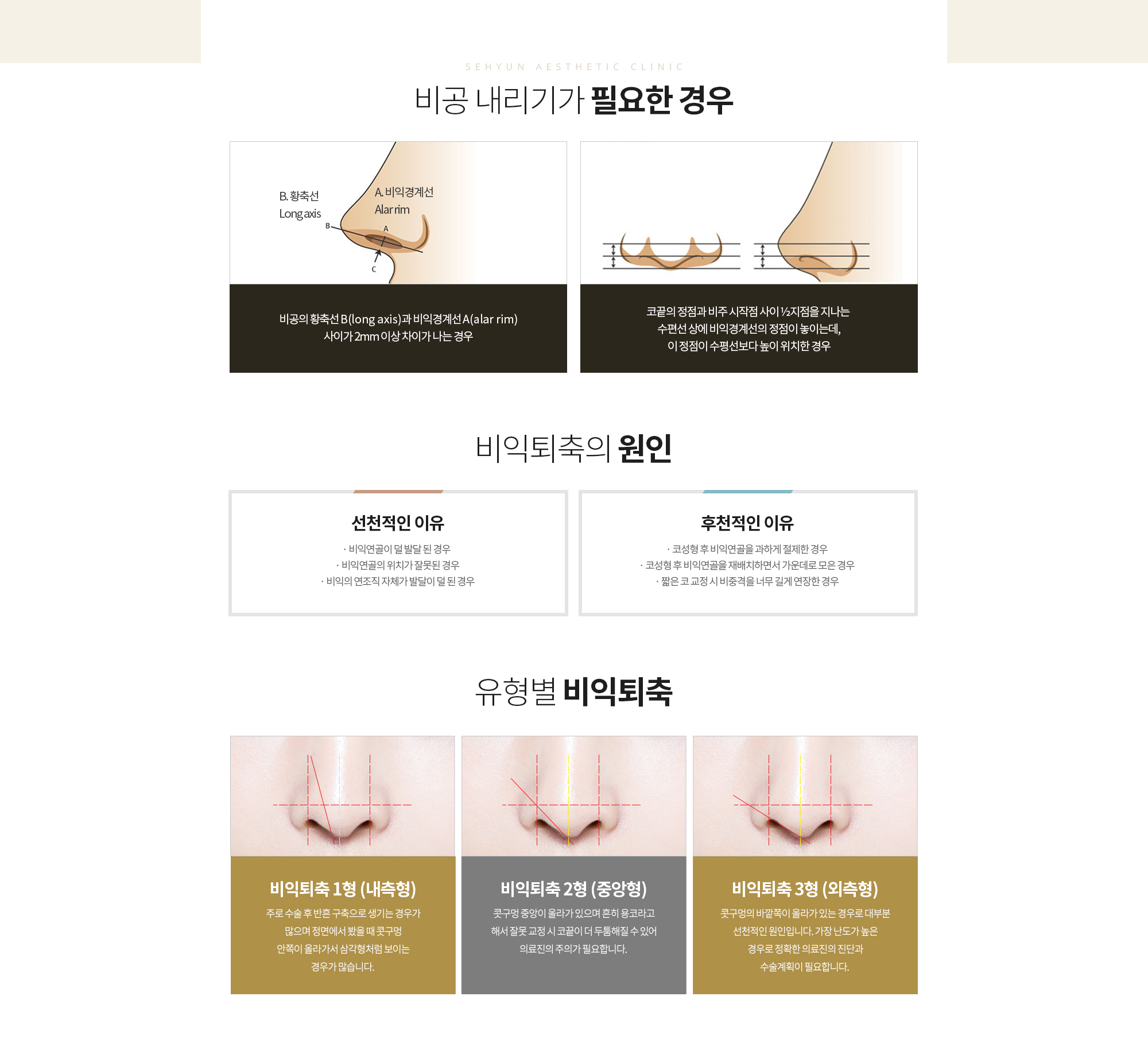 비공 내리기가 필요한 경우
		비공의 황축선 B(long axis)과 비익경계선A(alar rim) 사이가 2mm 이상 차이가 나는 경우
		코끝의 정점과 비주 시작점 사이 ½지점을 지나는 
		수편선 상에 비익경계선의 정점이 놓이는데,
		이 정점이 수평선보다 높이 위치한 경우