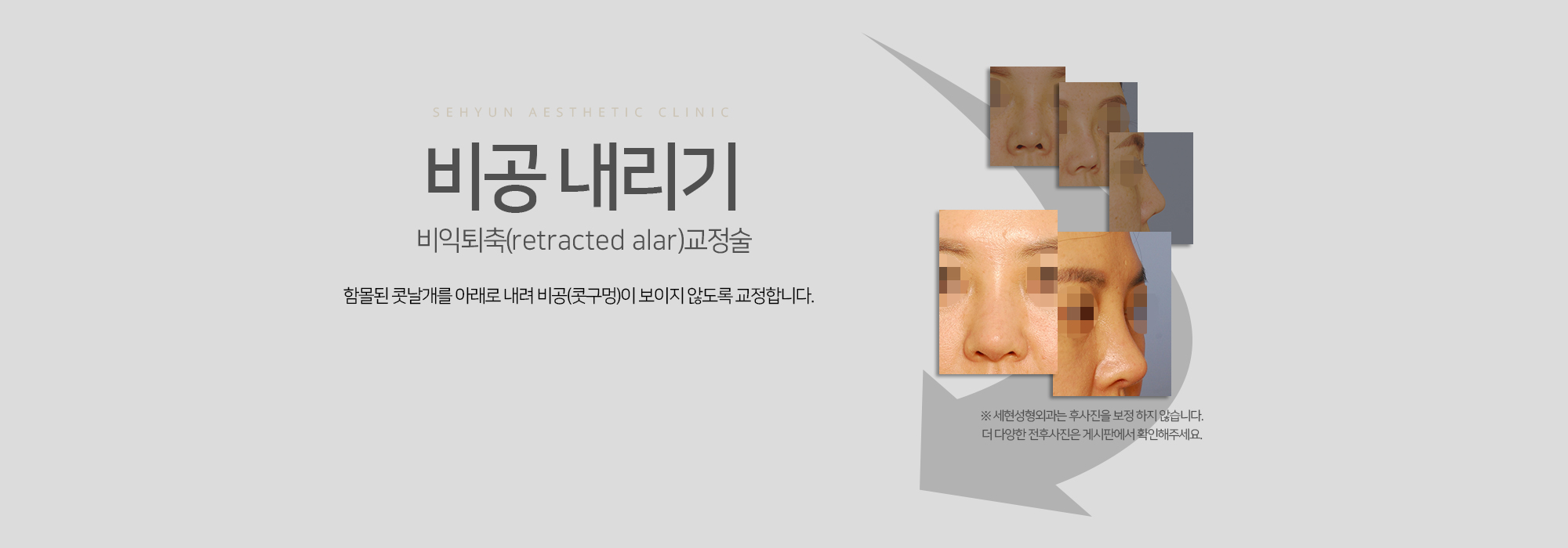 비공내리기 함몰된 콧날개를 아래로 내려 비공(콧구멍)이 보이지 않도록 교정합니다.