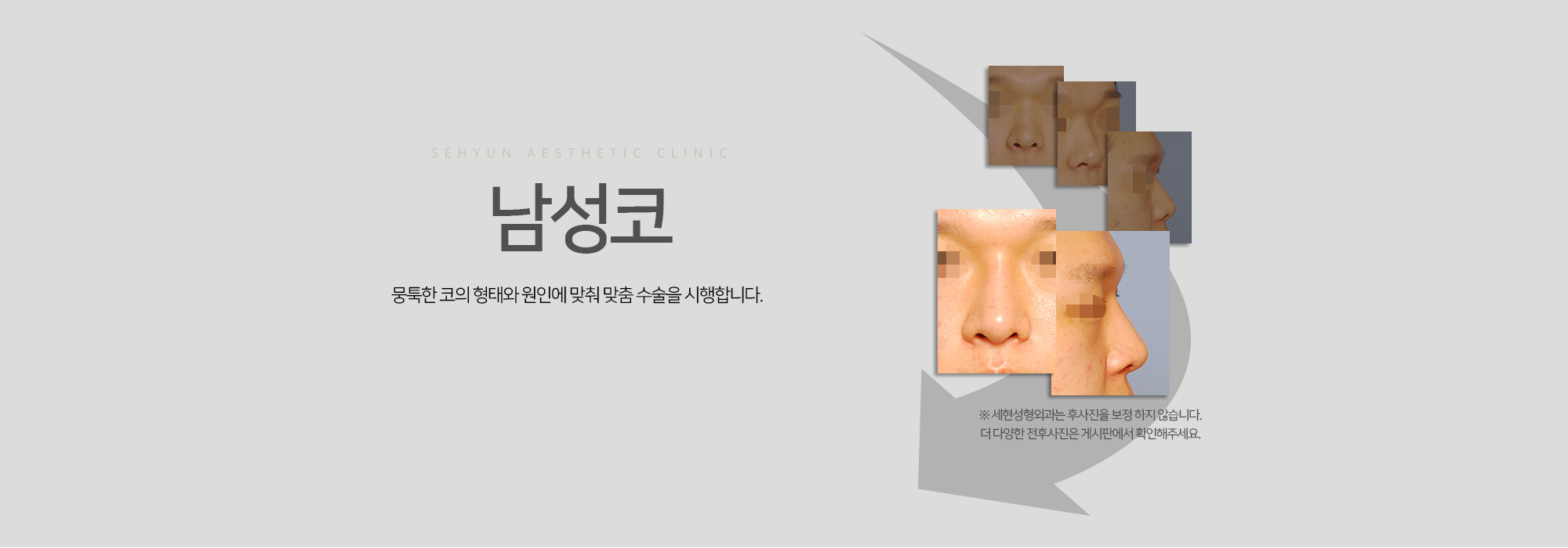 남성코 뭉툭한 코의 형태와 원인에 맞춰 맞춤 수술을 시행합니다.